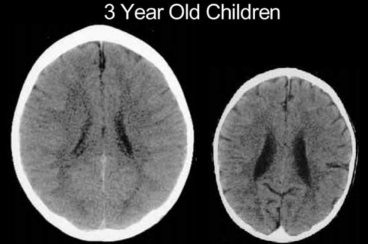 Ct scan neglect